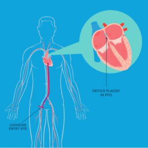 Device Closure of Patent Foramen Ovale (PFO) – Asian Heart and Vascular ...