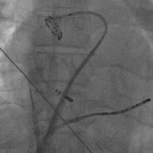 EP Study & Catheter Ablation – Asian Heart and Vascular Center